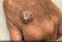 Squamous Cell Carcinoma