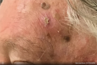 Squamous Cell Carcinoma