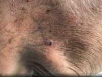 Basal Cell Carcinoma