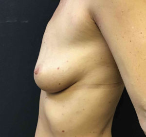 Breast Augmentation