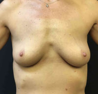 Breast Augmentation