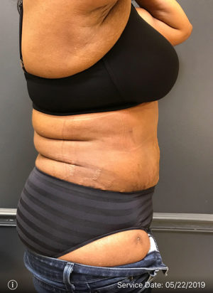 Tummy Tuck