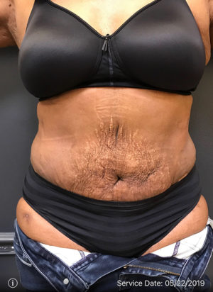 Tummy Tuck