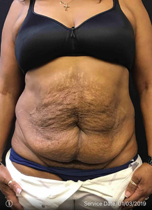 Tummy Tuck