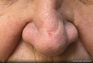 Basal Cell Carcinoma