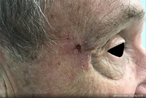 Basal Cell Carcinoma