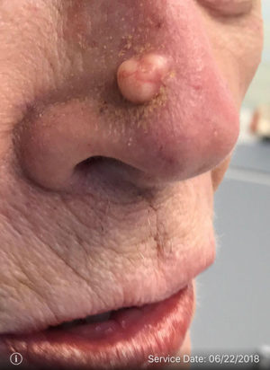 Basal Cell Carcinoma