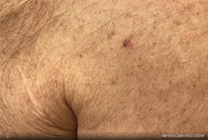 Basal Cell Carcinoma