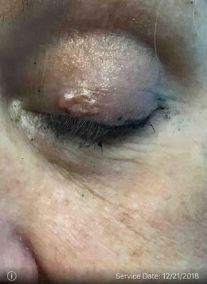 Basal Cell Carcinoma