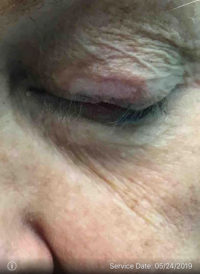 Basal Cell Carcinoma