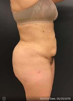 Liposuction