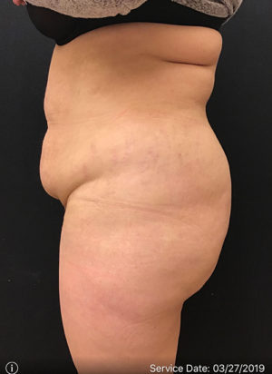 Liposuction