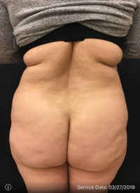 Liposuction