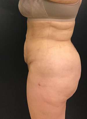 Liposuction