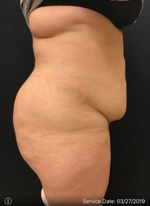 Liposuction