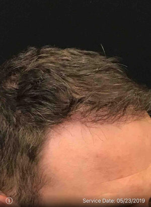 Neograft Hair transplantation