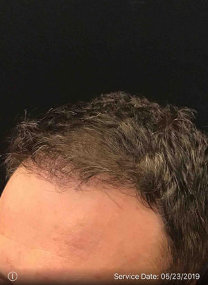 Neograft Hair transplantation