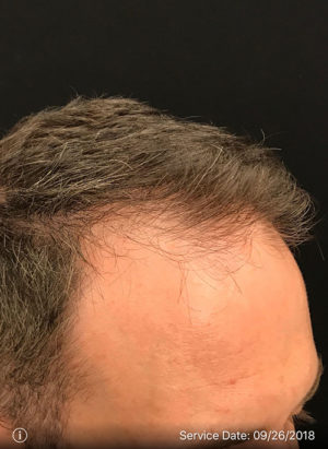 Neograft Hair transplantation