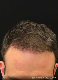 Neograft Hair transplantation