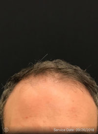 Neograft Hair transplantation