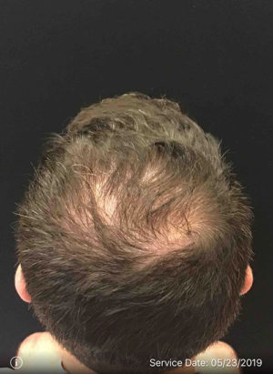 Neograft Hair transplantation