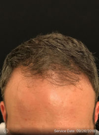 Neograft Hair transplantation