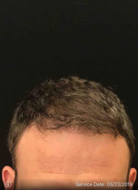 Neograft Hair transplantation