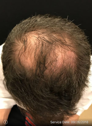 Neograft Hair transplantation