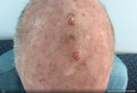 Squamous Cell Carcinoma