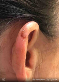 Basal Cell Carcinoma