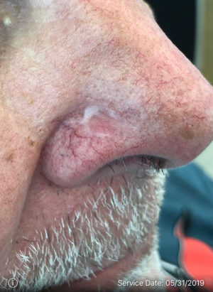 Basal Cell Carcinoma