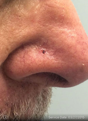 Basal Cell Carcinoma