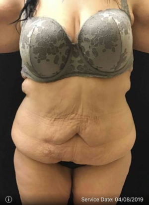 Tummy Tuck