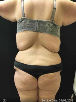 Tummy Tuck