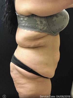 Tummy Tuck