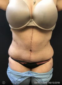 Tummy Tuck