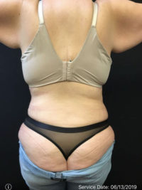 Tummy Tuck