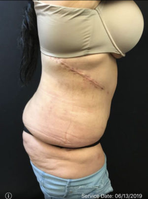 Tummy Tuck