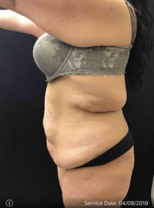 Tummy Tuck