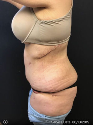 Tummy Tuck