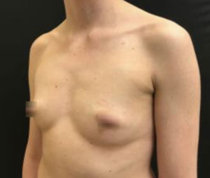 Breast Augmentation