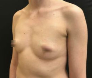 Breast Augmentation