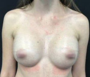 Breast Augmentation