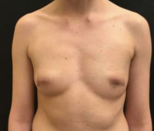 Breast Augmentation