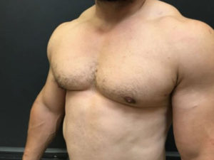 Gynecomastia