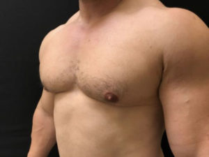 Gynecomastia