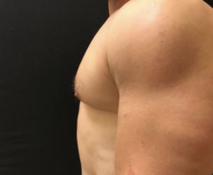 Gynecomastia