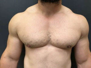 Gynecomastia