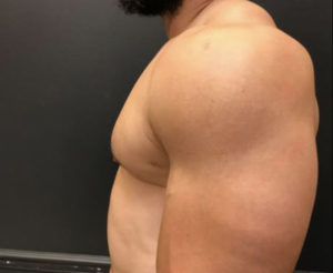 Gynecomastia