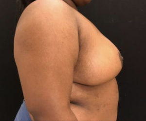 Breast Reduction
